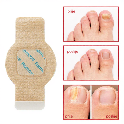 Elaimei™  Fungal Nail Patches